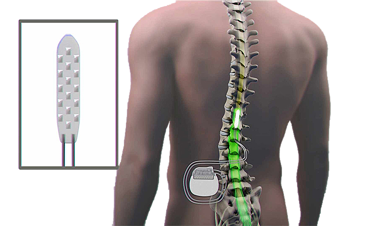 cost of spinal cord stimulator